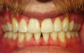 Patient after orthodontic treatment