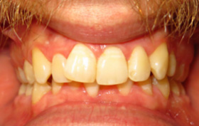 Patient before orthodontic treatment