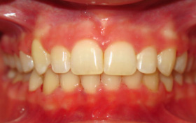 Patient after orthodontic treatment