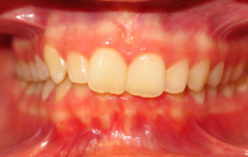Patient before orthodontic treatment