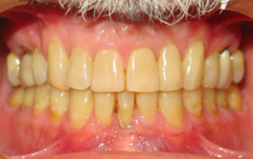 Patient after orthodontic treatment