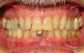 Patient before orthodontic treatment