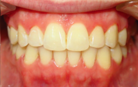 Patient after orthodontic treatment