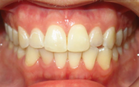 Patient before orthodontic treatment