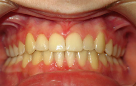Patient after orthodontic treatment