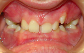 Patient before orthodontic treatment
