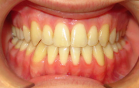 Patient after orthodontic treatment