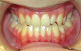 Patient before orthodontic treatment