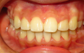 Patient after orthodontic treatment