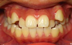 Patient before orthodontic treatment