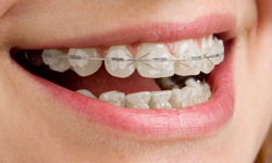 Clear ceramic braces