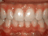 Deep overbite, after treatment