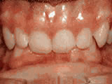 Deep overbite, before treatment
