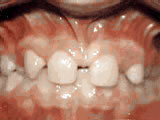 Missing lateral incisors, before treatment