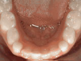 Non-braces treatment, after