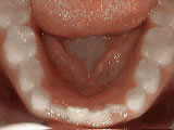 Non-braces treatment, before