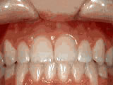 Open bite, after treatment