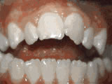 Open bite, before treatment
