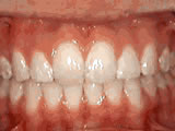 Overjet, after treatment