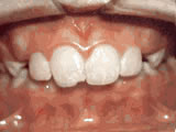 Overjet, before treatment