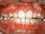 Phase One treatment, after