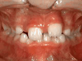 Phase One treatment, before