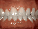 Spacing of teeth, after treatment