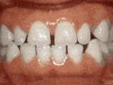 Spacing of teeth, before treatment