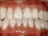 Underbite, after treatment