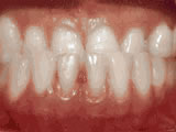 Underbite, before treatment